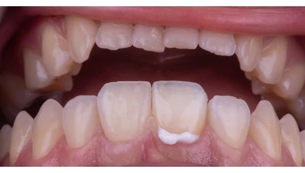 Traumás fog helyreállítása: egy biomimetikus megközelítés