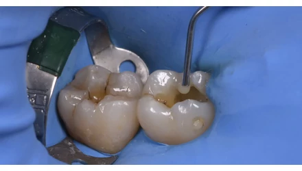 Amalgám helyettesítése folyékony kompozittal – részletes klinikai esetmagyarázattal