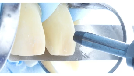 Klinikai esetbemutatás: Teljes adhéziós ragasztási protokoll PANAVIA™ Veneer LC használatával