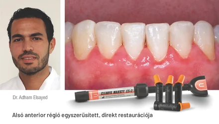 Alsó anterior régió egyszerűsített direkt restaurációja